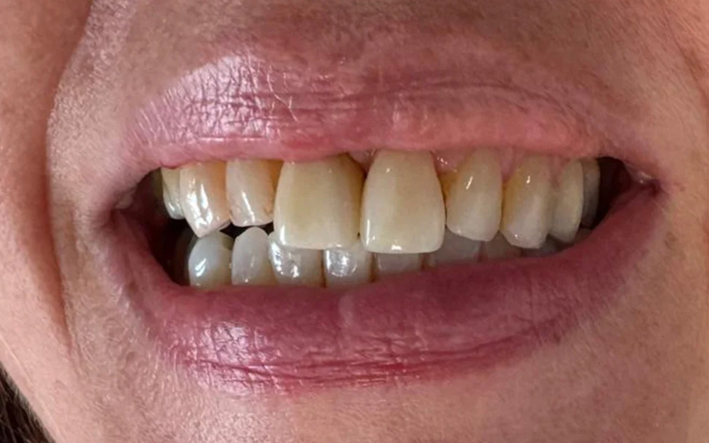 After treatment