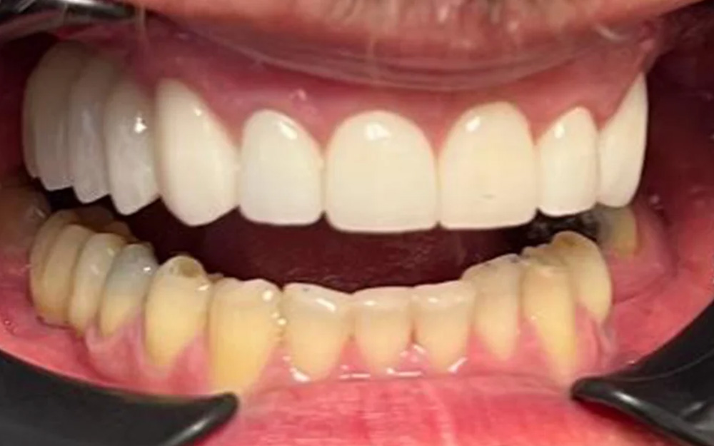 After treatment