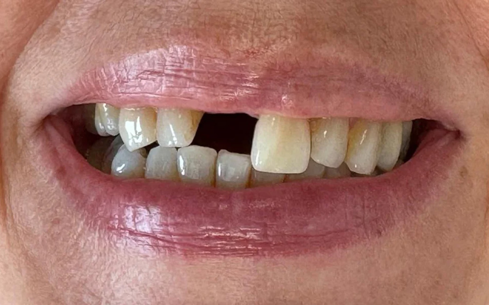 Before treatment