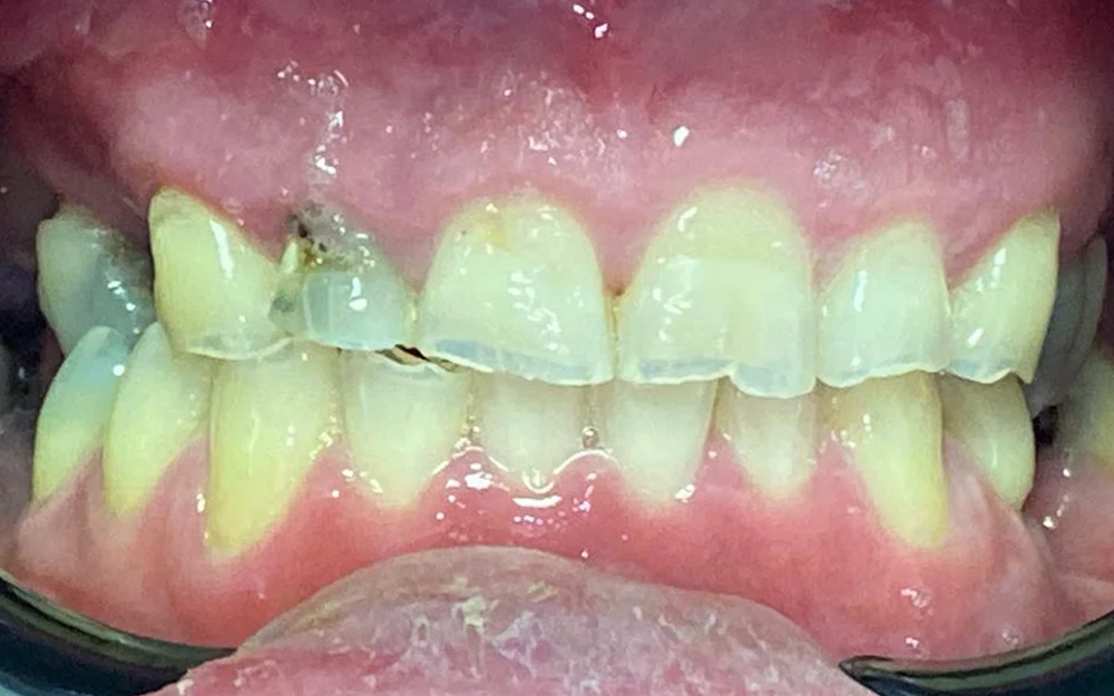 Before treatment