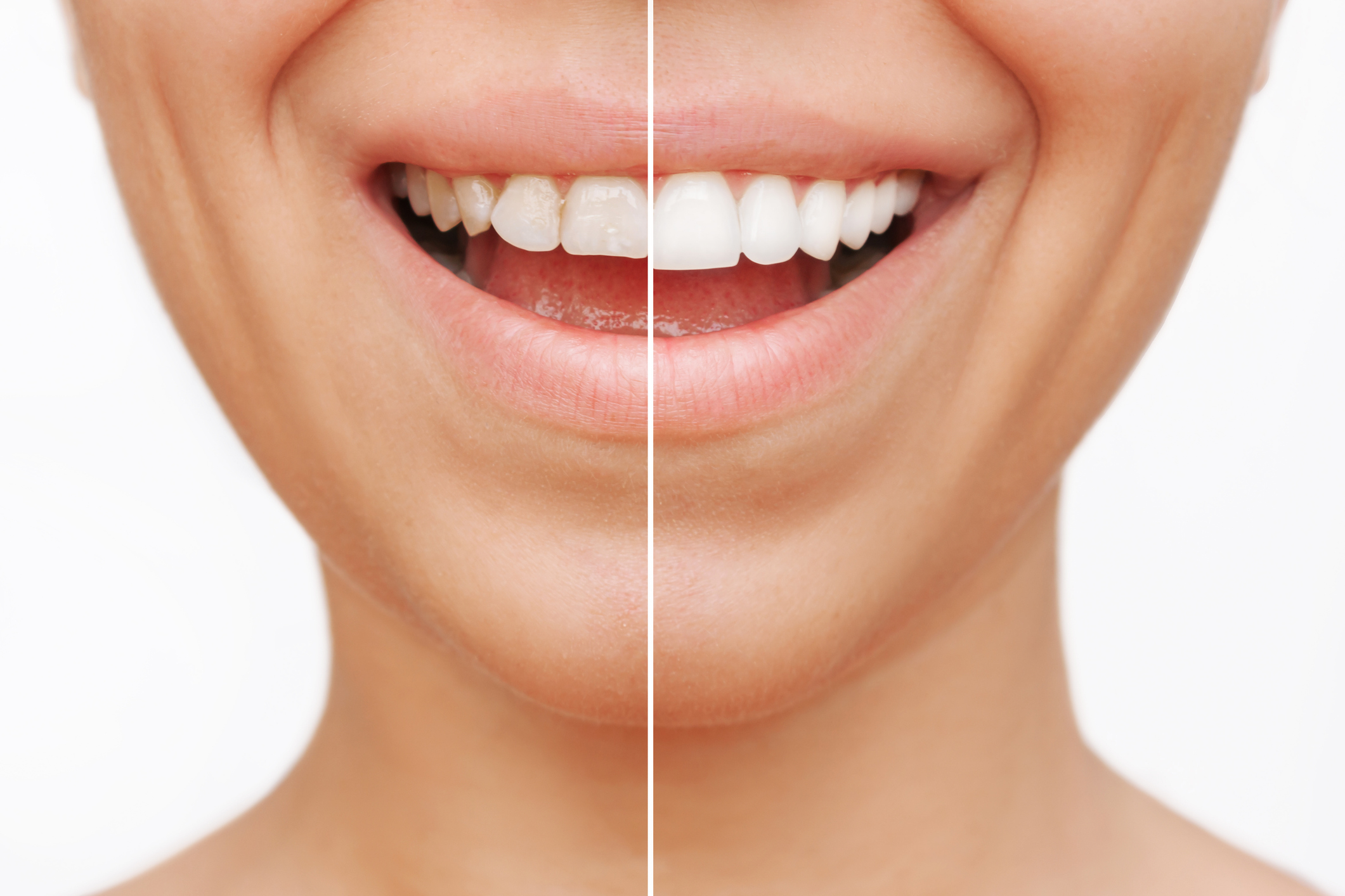 before and afters of dental veneers