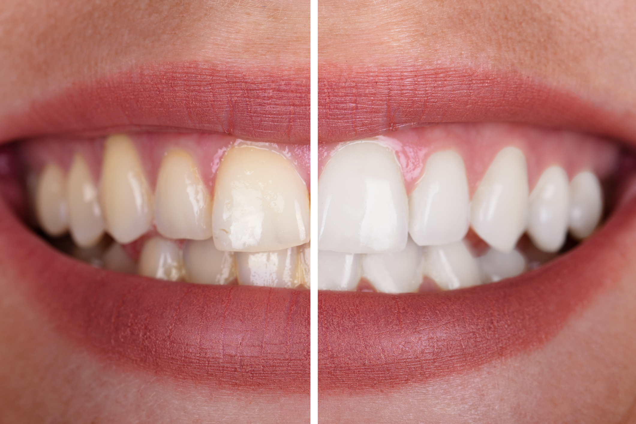 How to Whiten Your Teeth Safely in Aberdeen