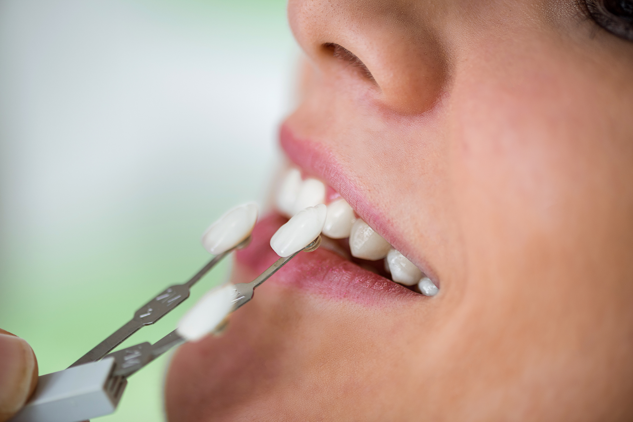 Teeth Whitening in Aberdeen: The Complete Guide