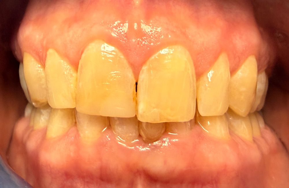 before image
