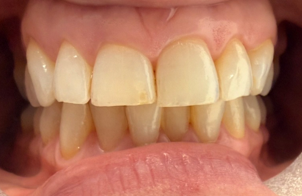 before image