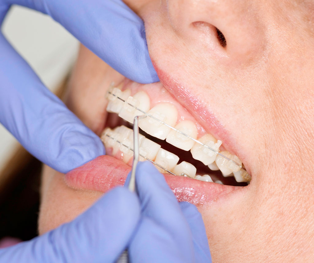 Ceramic clear fixed braces