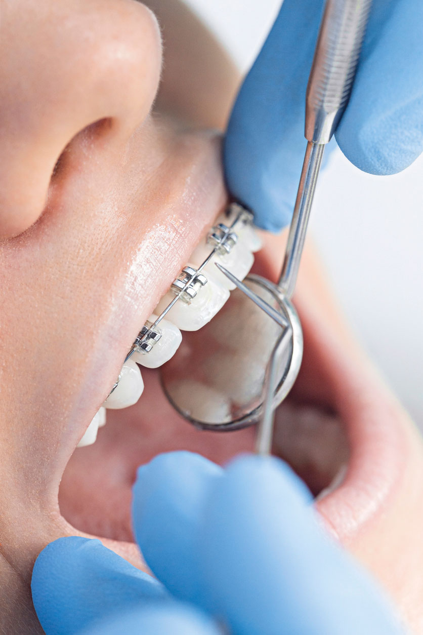 Fixed brace inspection