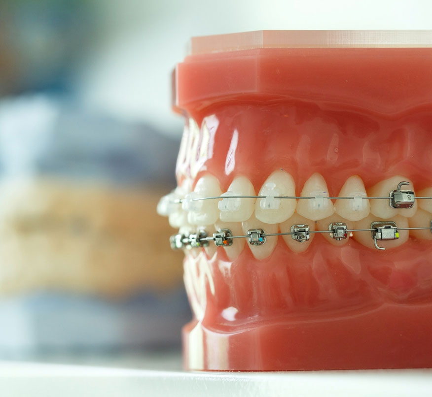 Fixed braces model