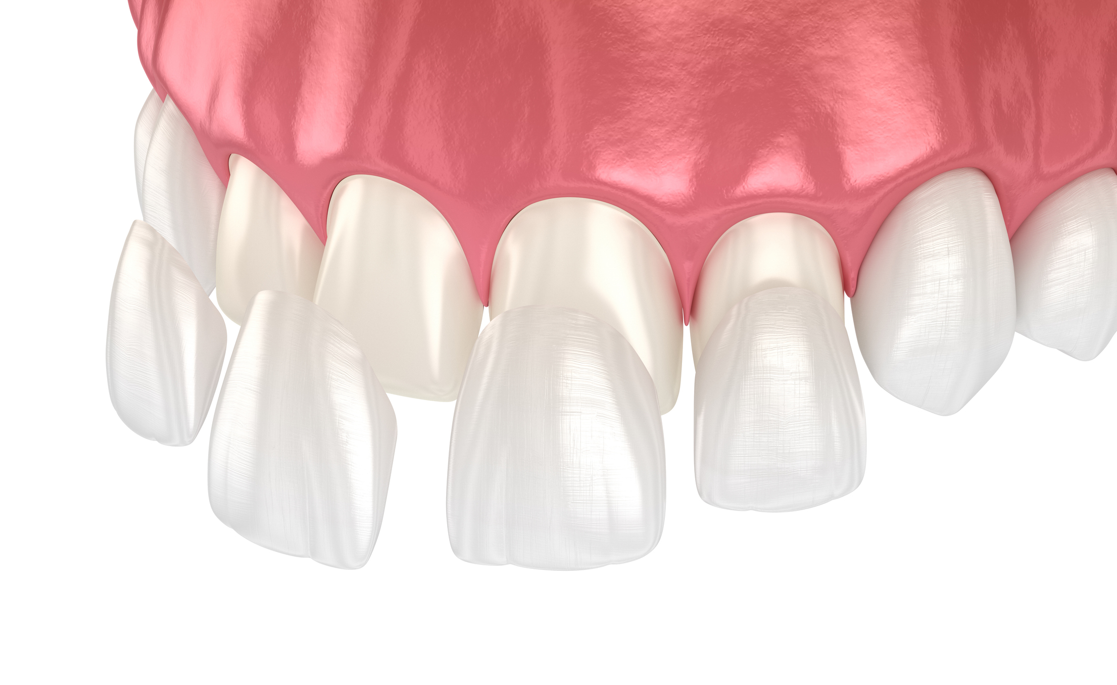 3D illustration of dental veneer placement over frontal teeth