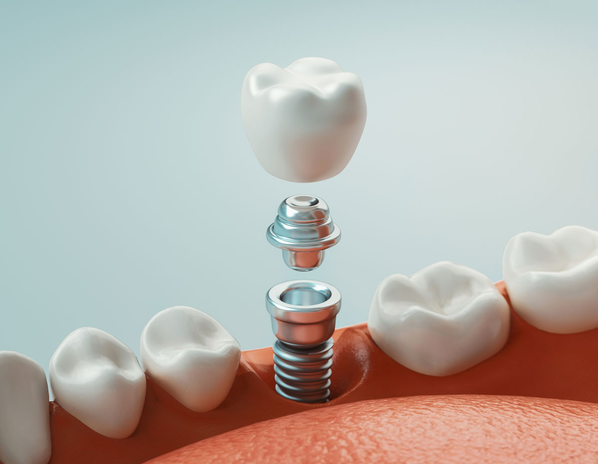 Dental implant 3d render